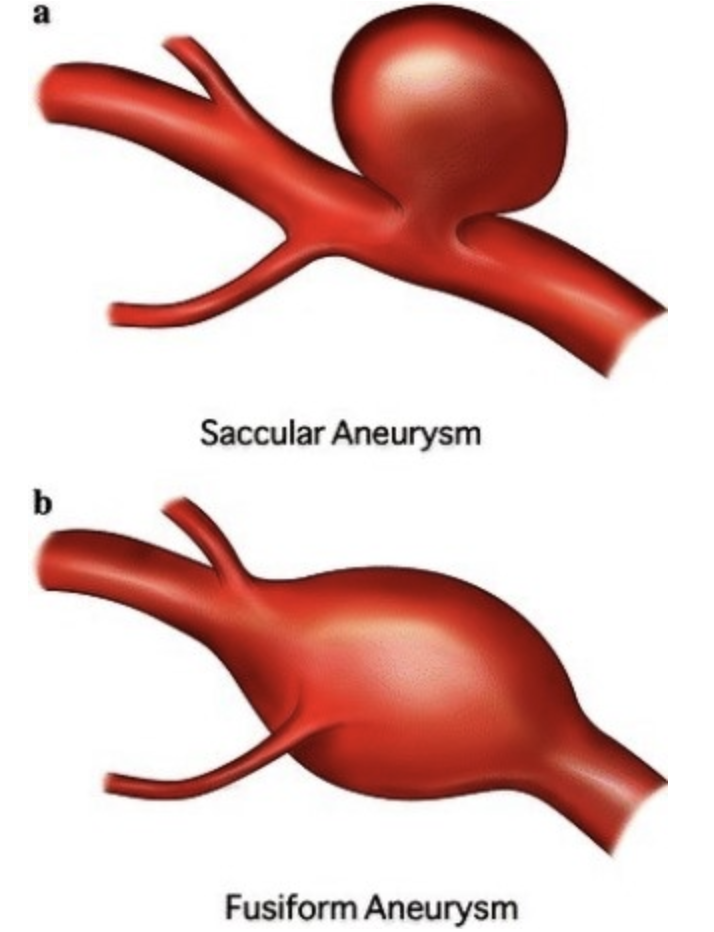 [Cardiovascular disease] Aneurysm _ part1