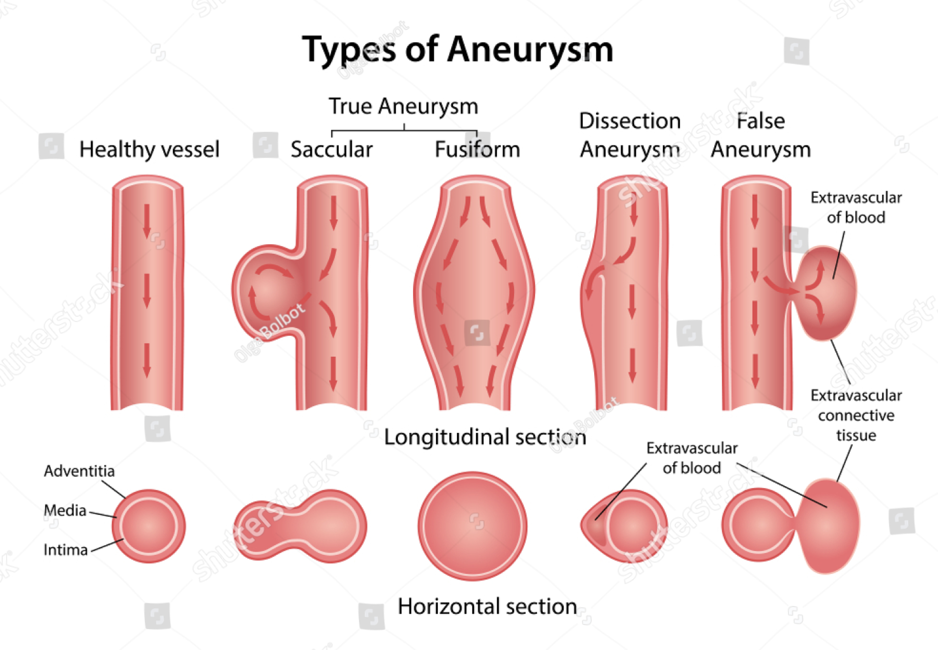 [Cardiovascular disease] Aneurysm _ part1