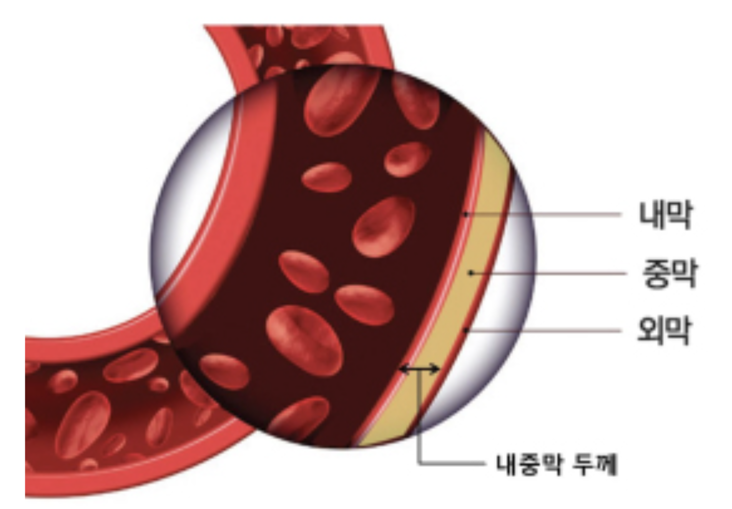[Cardiovascular disease] Aneurysm _ part1