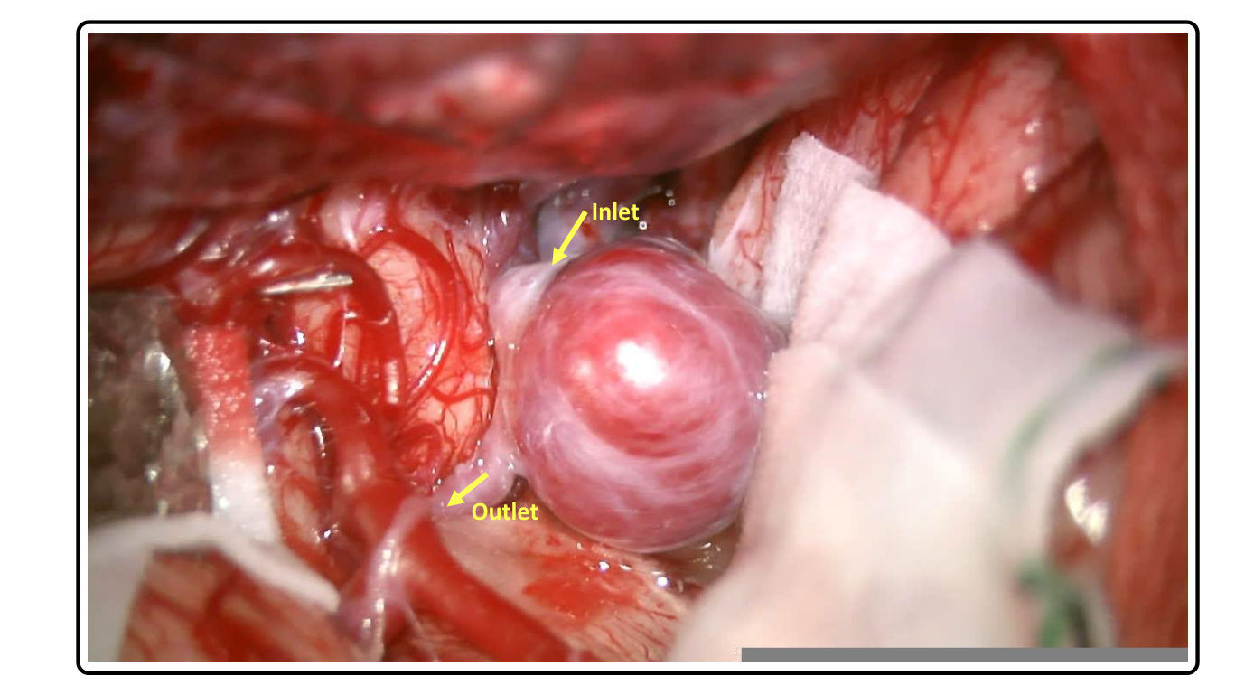 [Cardiovascular disease] Aneurysm _ part1