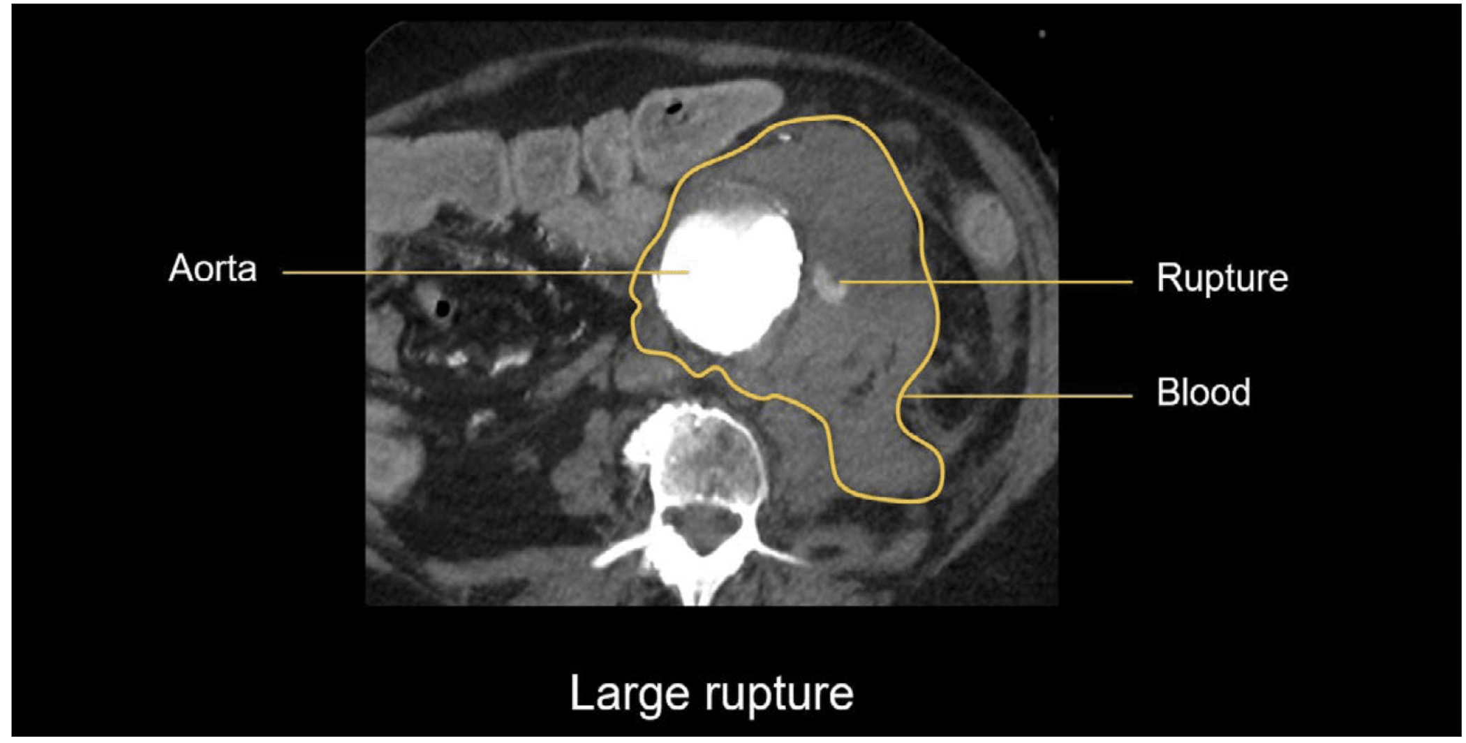 [Cardiovascular disease] Aneurysm _ part2_ CT