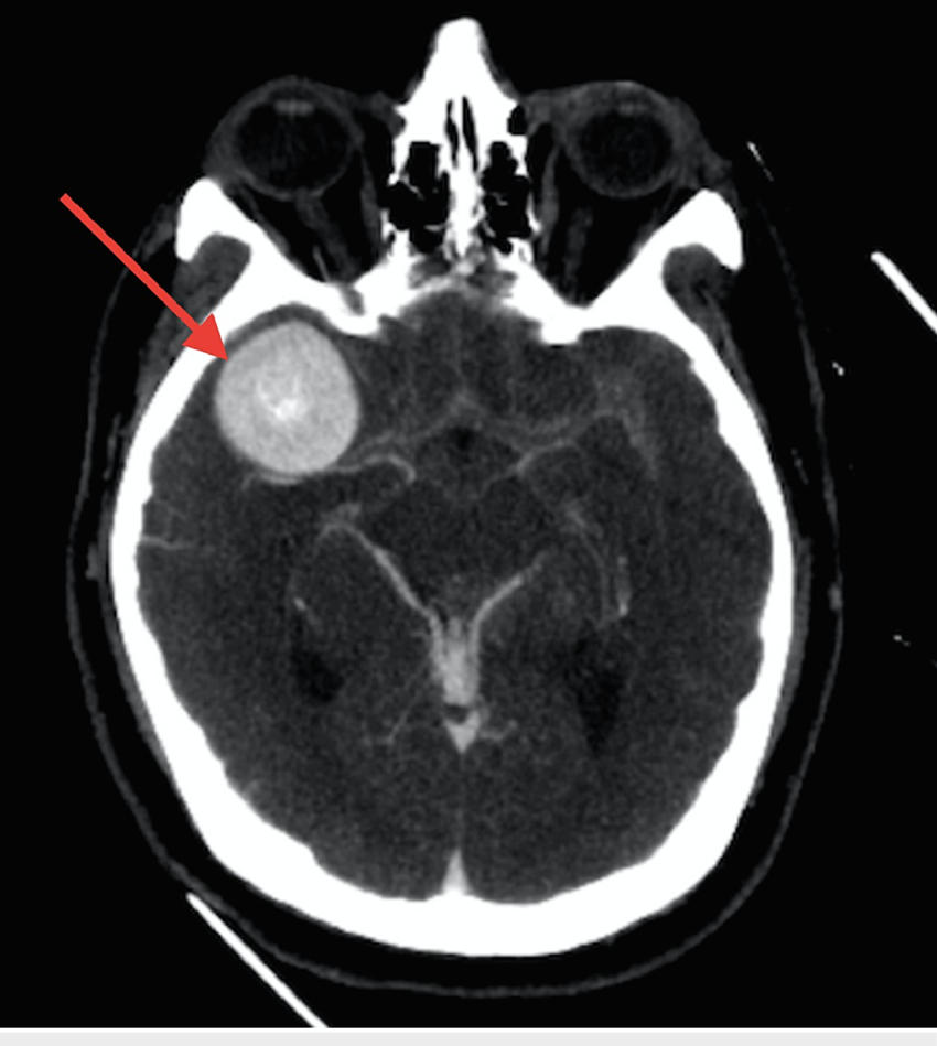 [Cardiovascular disease] Aneurysm _ part2_ CT