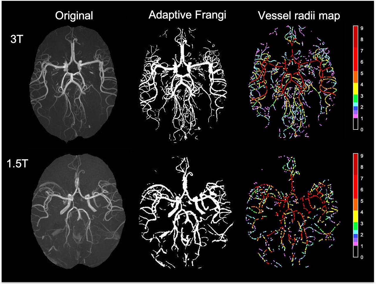 [Cardiovascular disease] Aneurysm _ part2_MRA