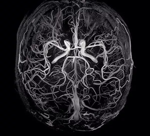 [Cardiovascular disease] Aneurysm _ part2_MRA
