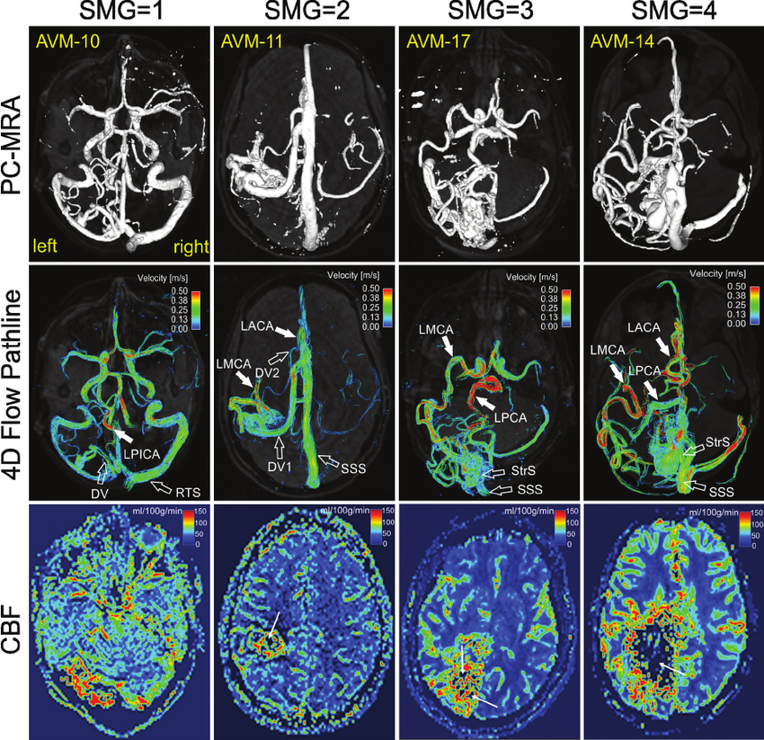 [Cardiovascular disease] Aneurysm _ part2_MRA