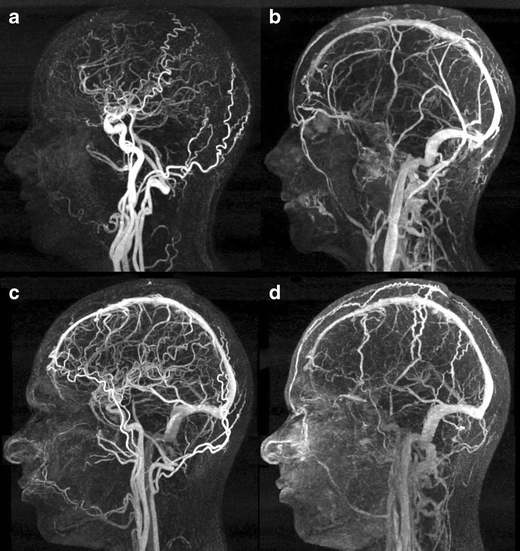 [Cardiovascular disease] Aneurysm _ part2_MRA