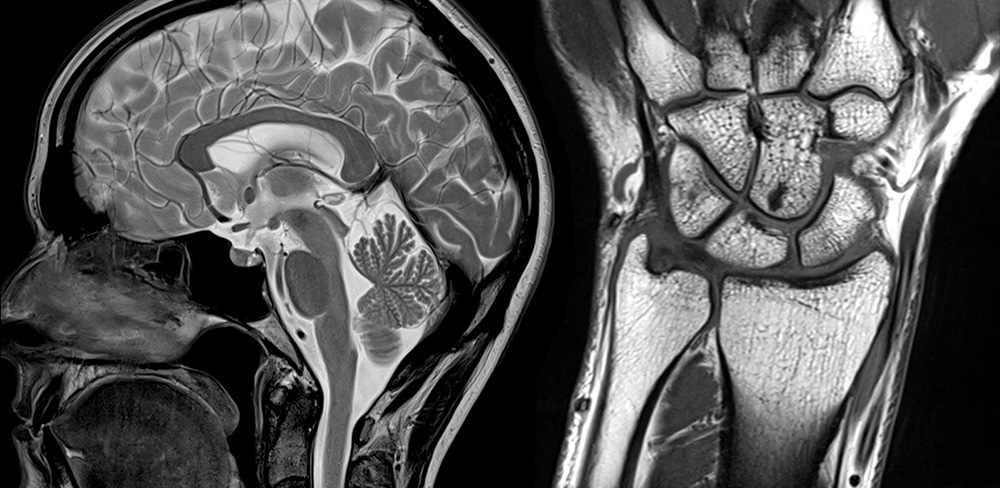 [Cardiovascular disease] Aneurysm _ part2_MRI