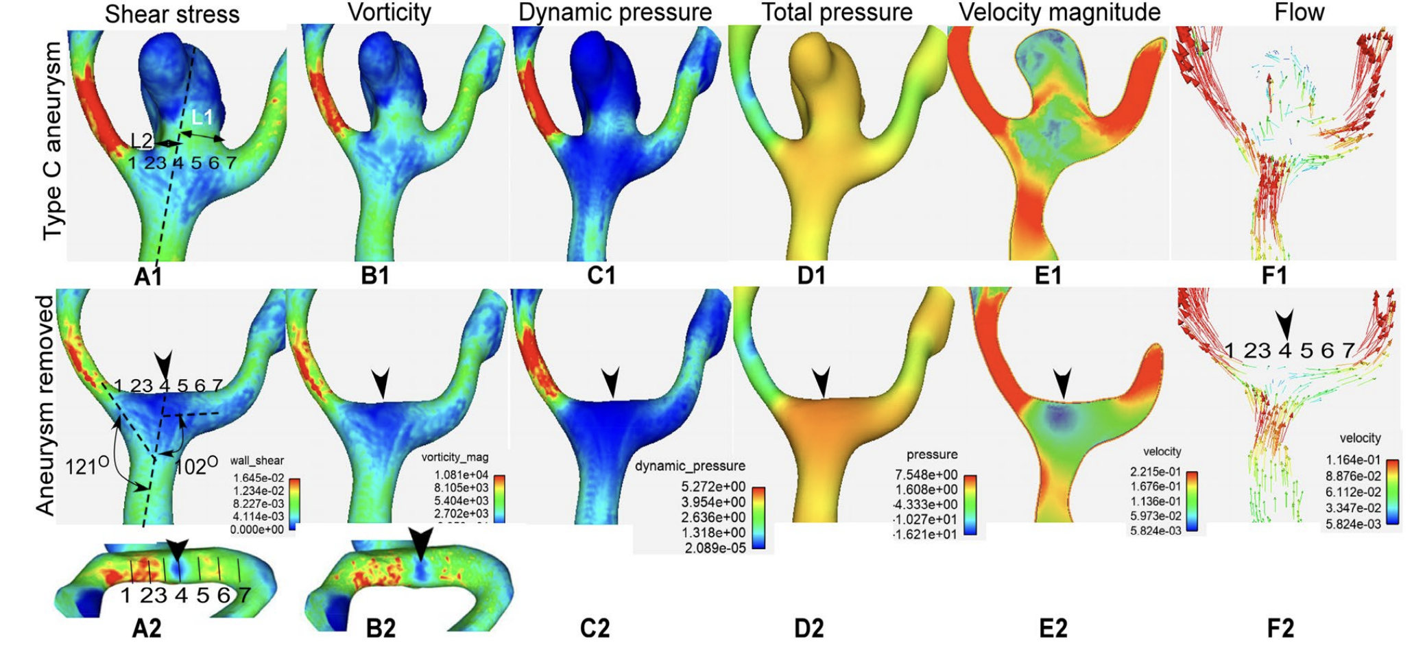 [Cardiovascular disease] Aneurysm _ part3