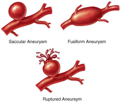 [Cardiovascular disease] Aneurysm _ part3