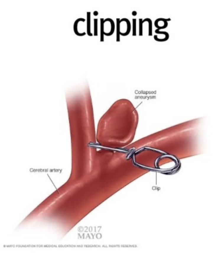 [Cardiovascular disease] Aneurysm _ part4