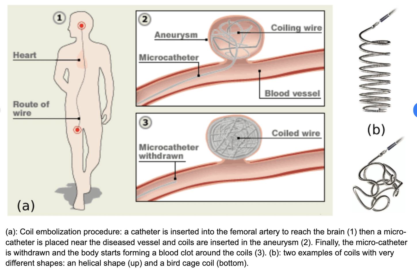 [Cardiovascular disease] Aneurysm _ part4