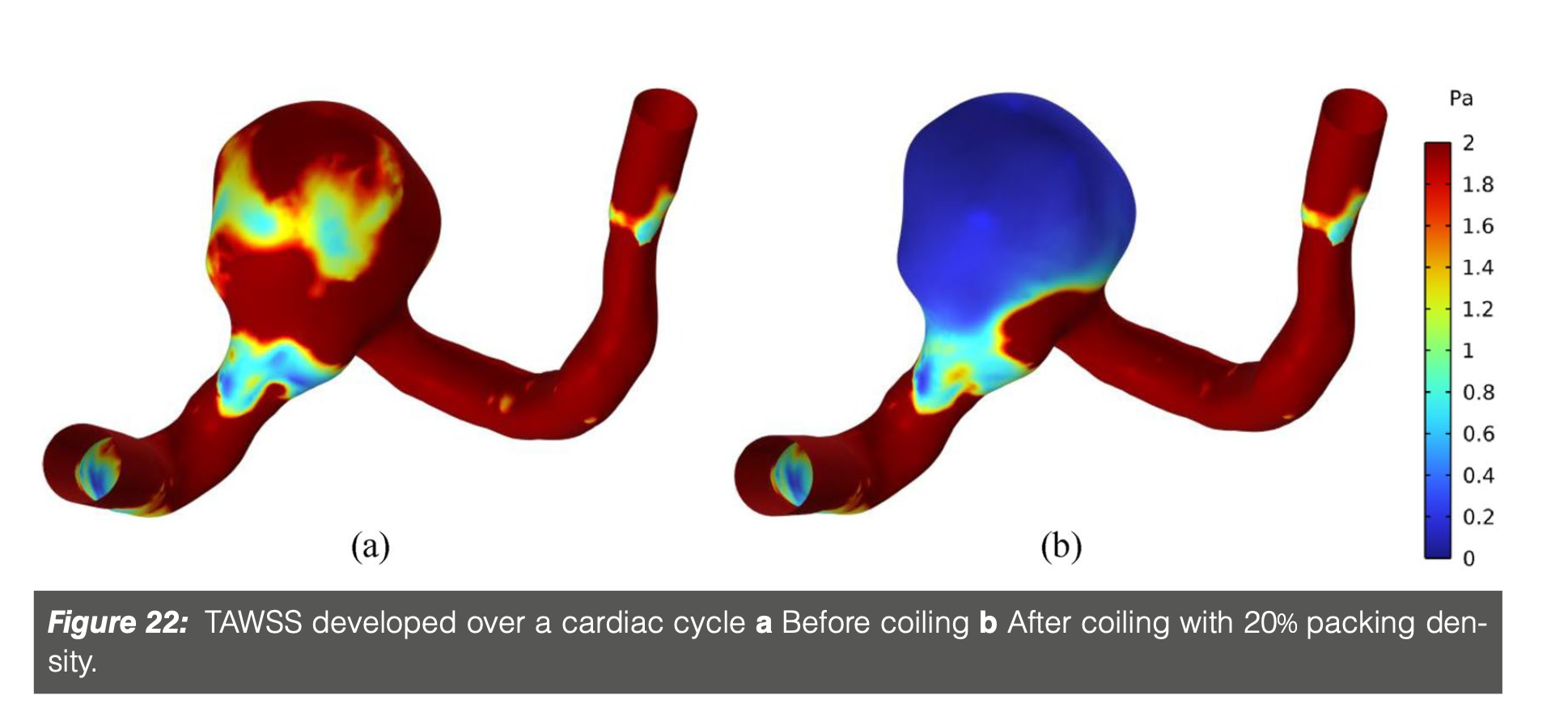 [Cardiovascular disease] Aneurysm _ part4