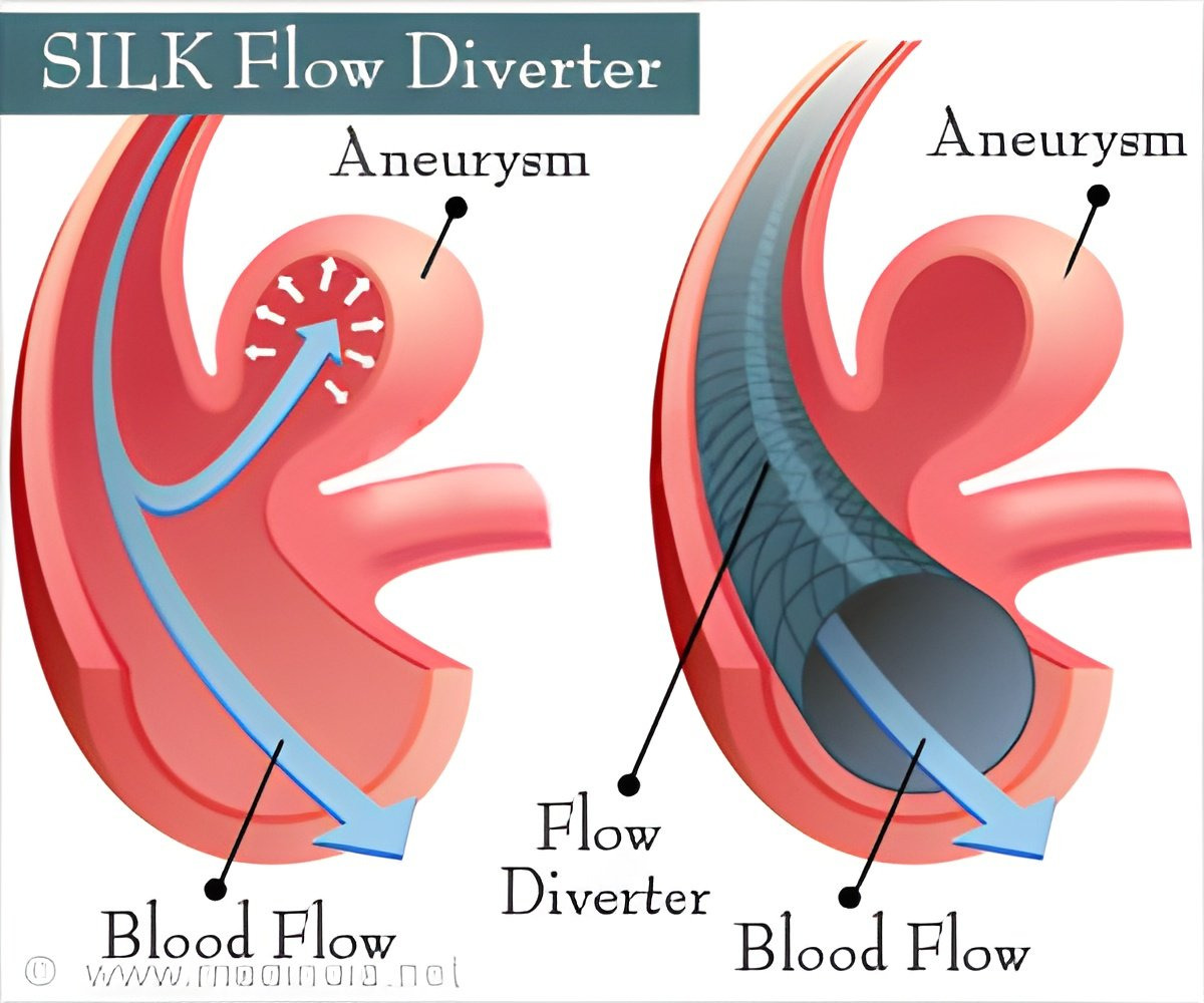 [Cardiovascular disease] Aneurysm _ part4