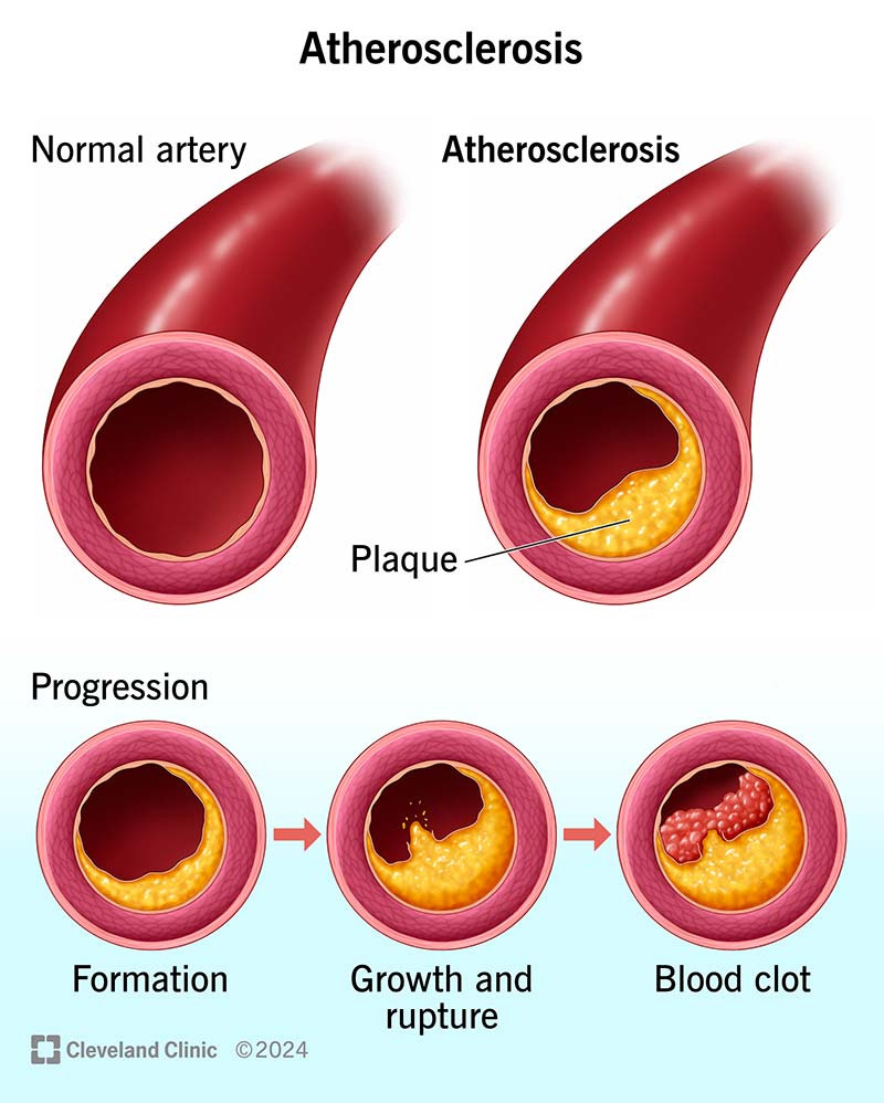 Calcification on Coronary Artery - Plaque composition 1