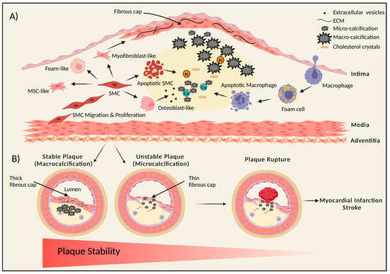 Calcification on Coronary Artery - Plaque composition 1