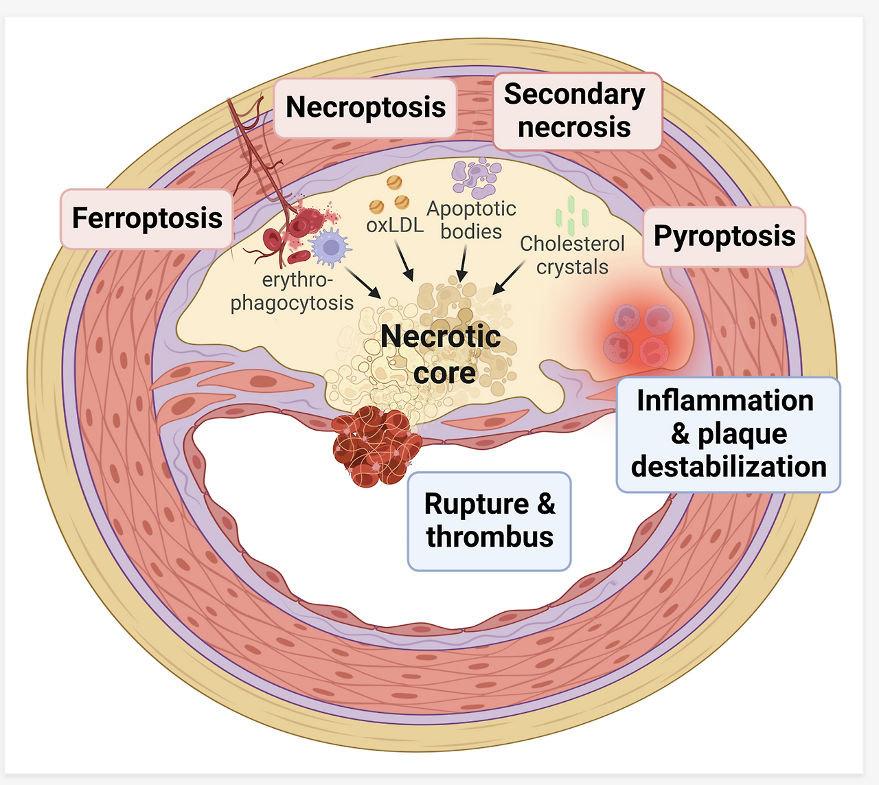 Calcification on Coronary Artery - Plaque composition 1