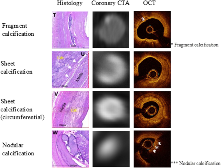 Calcification on Coronary Artery - Plaque composition 1