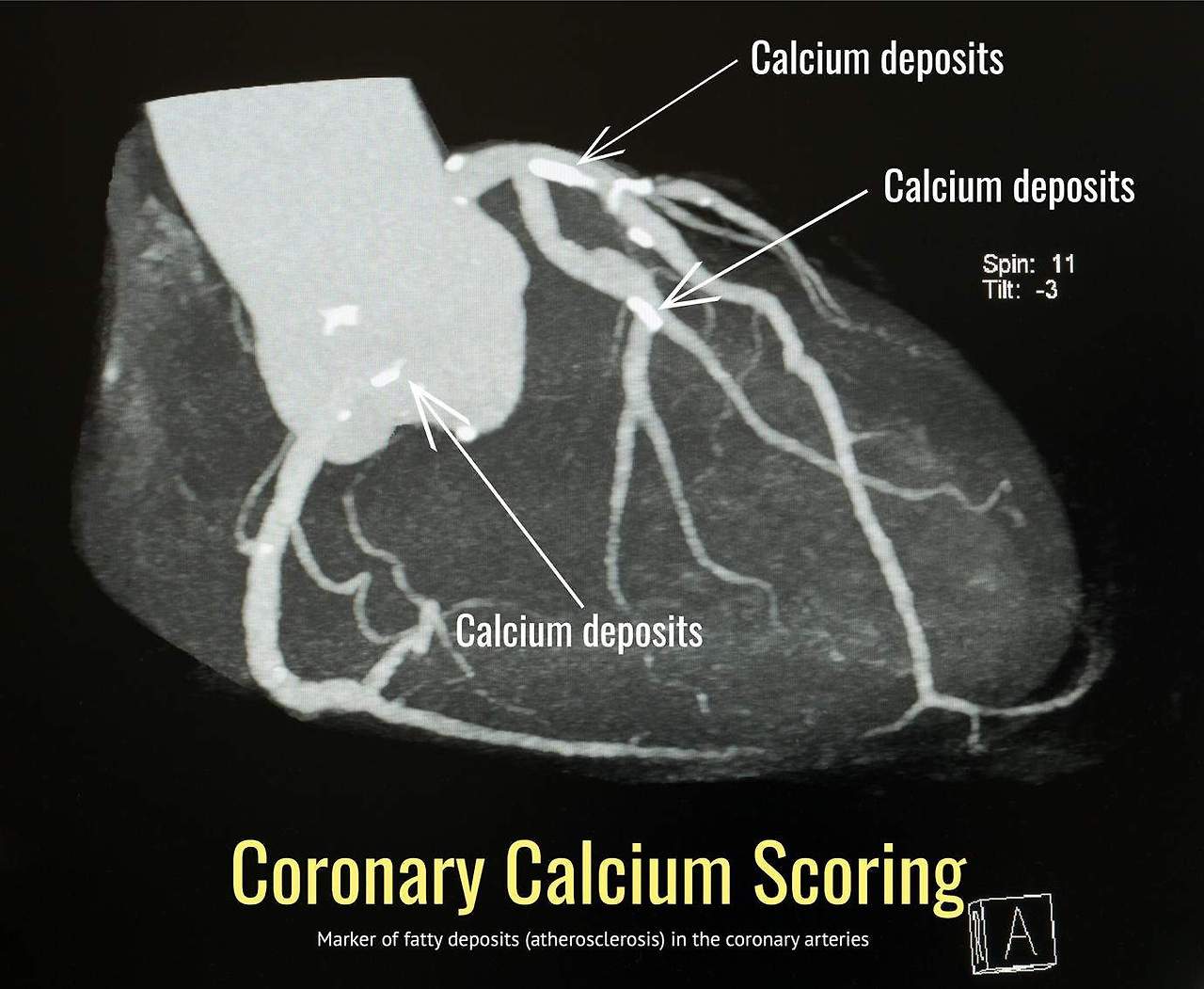 Calcification on Coronary Artery - Plaque composition 1