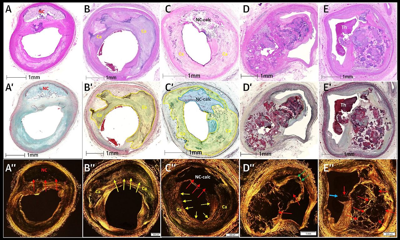 Calcification on Coronary Artery - Plaque composition 1