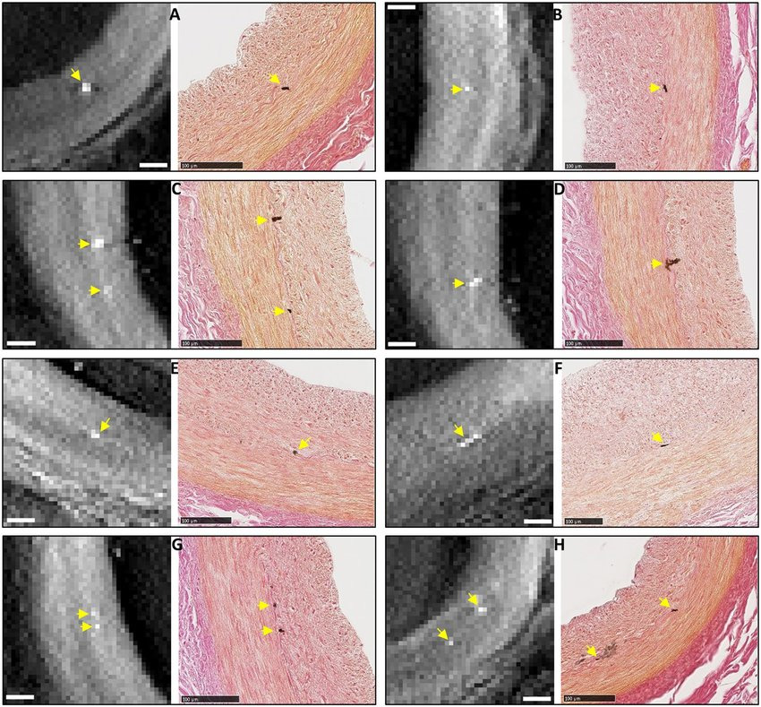 Calcification on Coronary Artery - Plaque composition 1