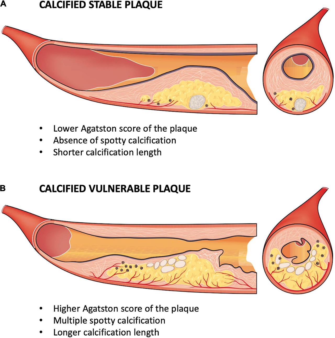 Calcification on Coronary Artery - Plaque composition 1