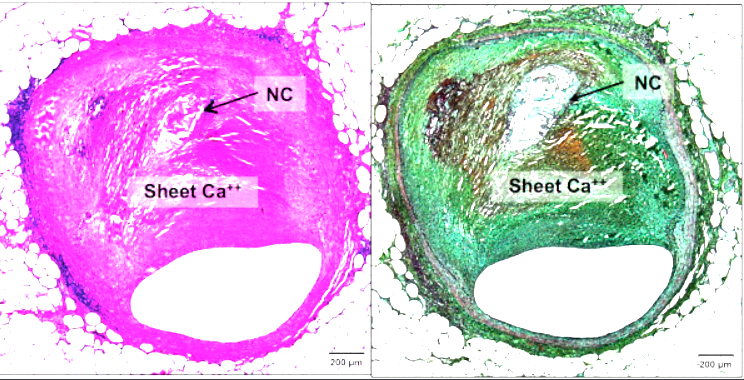Calcification on Coronary Artery - Plaque composition 1