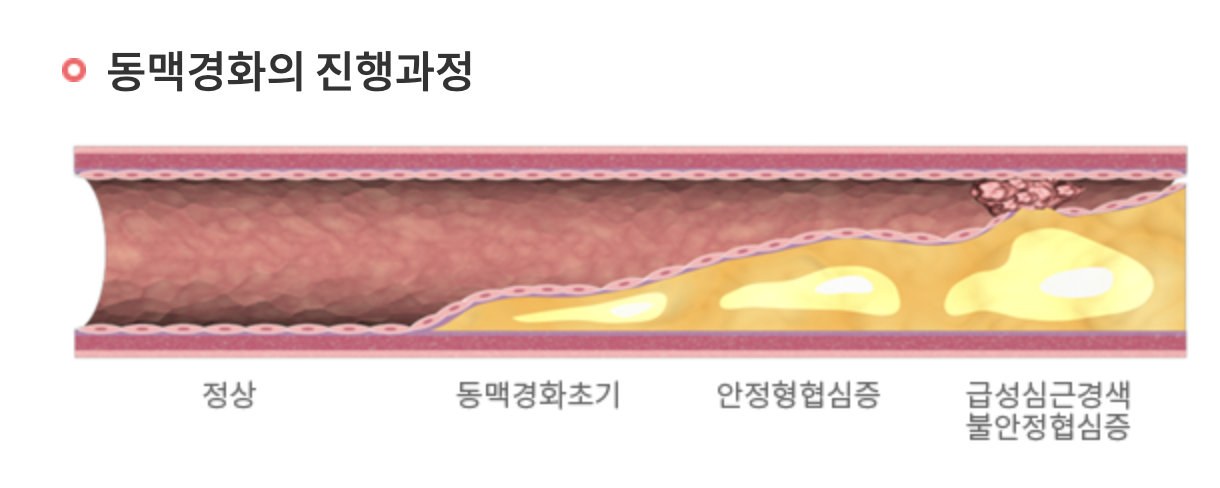 [Cardiovascular disease] 1. Plaque