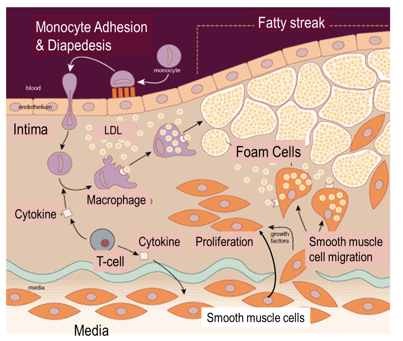[Cardiovascular disease] 1. Plaque