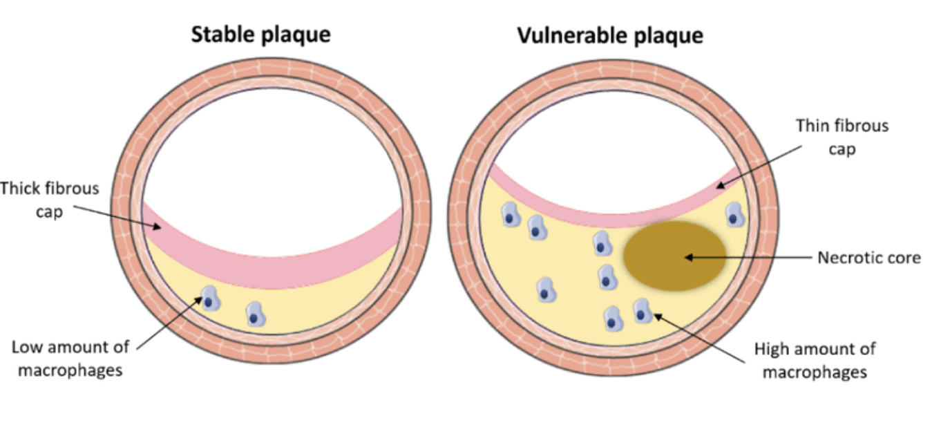 [Cardiovascular disease] 1. Plaque